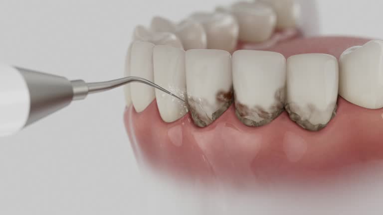 Trusted Wisdom Tooth Removal service in Winchester, KY - Dentist Open Now
